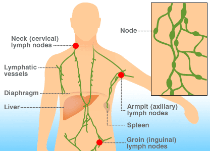 lymphoma cancer