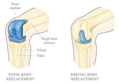 partial knee replacement