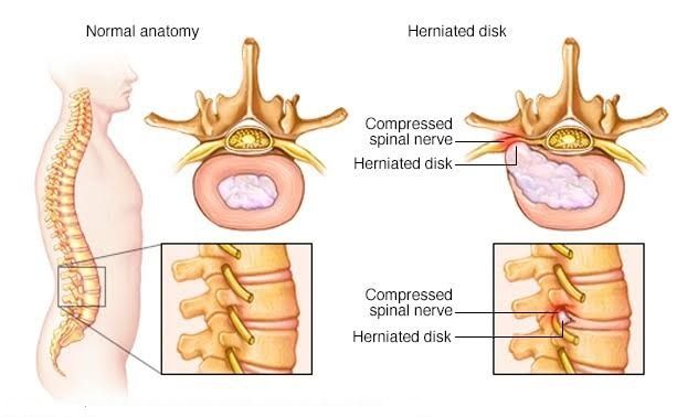 cause of slipped disc