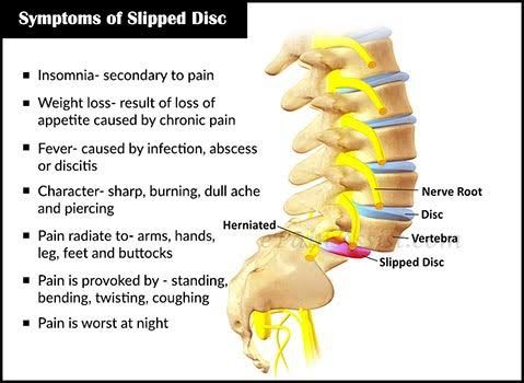 cause of slipped disc