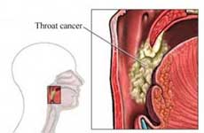 Throat cancers