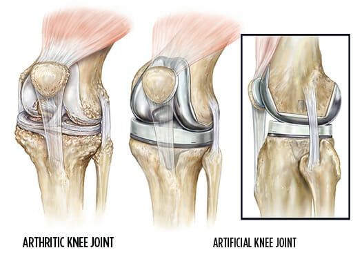 knee replacement