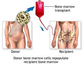 Pediatric Bone Marrow Transplant