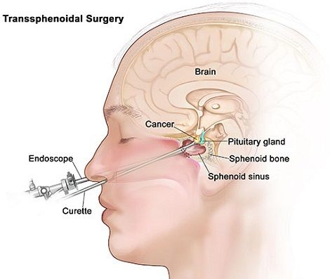 Using ClearPoint in Surgery for Patients with Brain Tumors, Dr