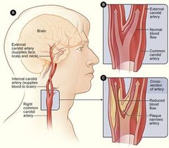 Carotid Endarterectomy Surgery, Aortic Aneurysm Repair Surgery, Aortic Aneurysm Repair Surgery India, Aortic Aneurysm Repair, Aortic Aneurysm Repair Surgery India, Aortic Aneurysm Repair Surgery India, Aortic Aneurysm Repair Surgery Price, Aneurysm Repair