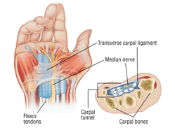 Carpal Tunnel Syndrome