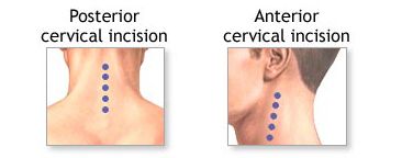 Anterior or Posterior