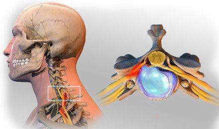 cervical herniated disc