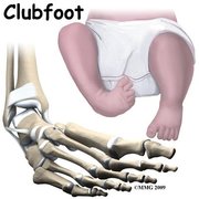 Club Foot