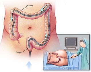 Colonoscopy