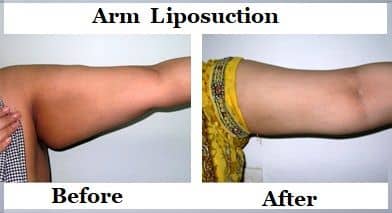 Liposuction Surgery in Hyderabad