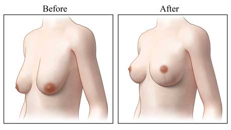 Breast Lift