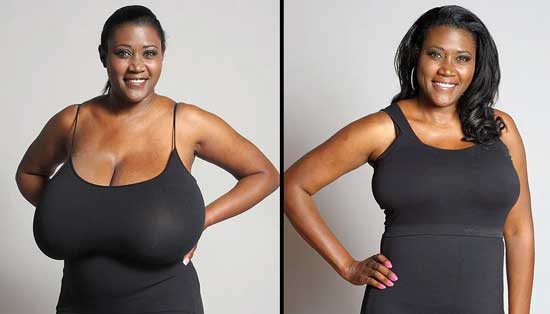 Breast Reduction Surgery/Reduction