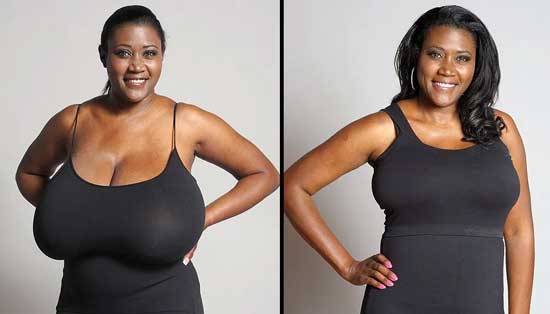 Breast Reduction Update - 5 Years On — Inside Out Style