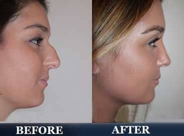 Rhinoplasty