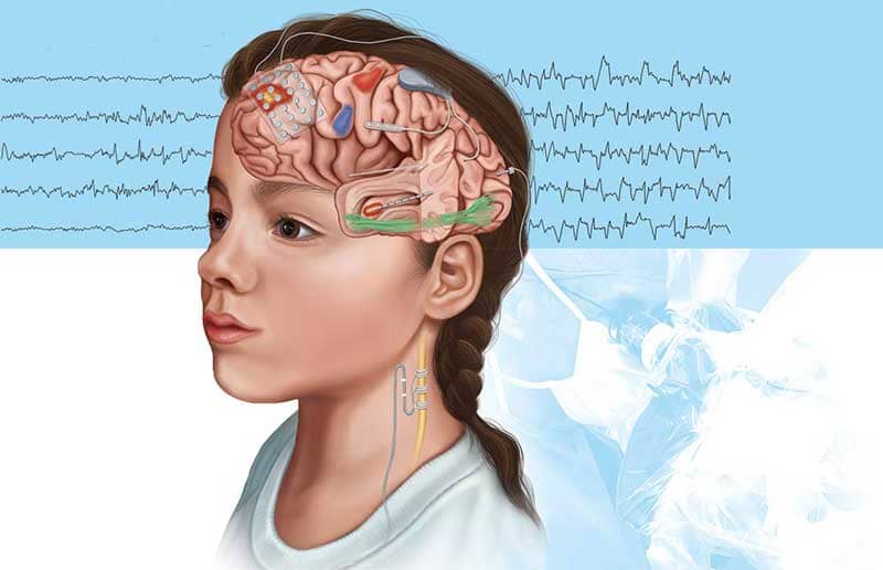 Epilepsy Surgery cost in india