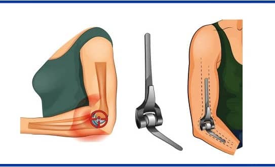 Elbow Replacement Surgery cost in India
