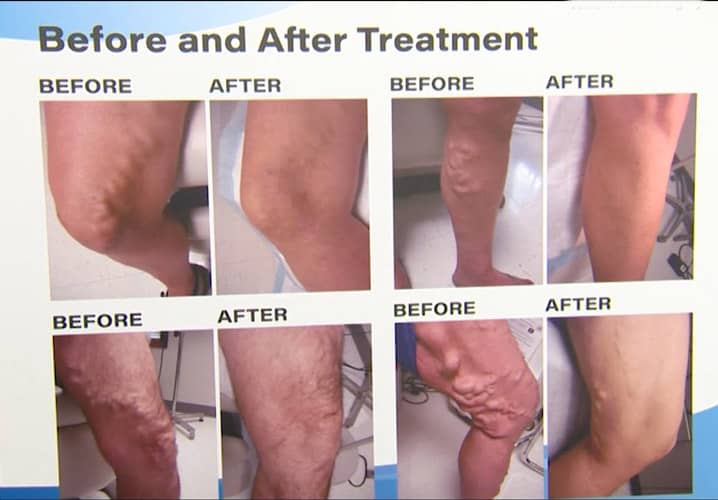 Non Surgical Treatment for Varicose Veins Cost in India