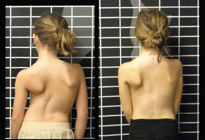 Scoliosis Surgery Cost in India