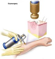 cryosurgery