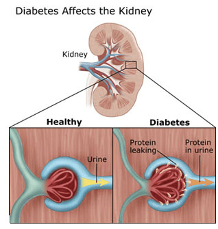 diabetes-causes