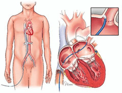 Radio Frequency Catheter Ablation