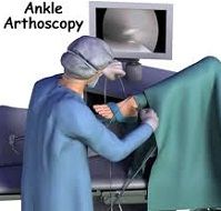 Ankle replacement Surgery