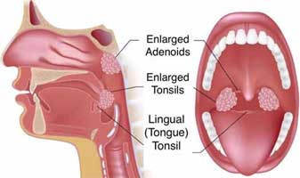 Tonsillectomy Surgery