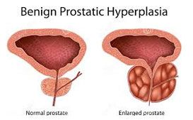 Prostate Cancer