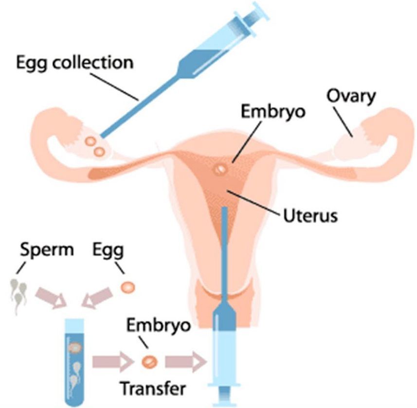 In Vitro Fertilization