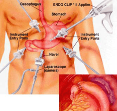 Fundoplication for GERD, Hiatal Hernia