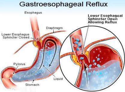 Causes Gastroesophageal Reflux Disease