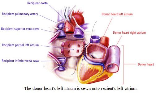 Heterotopic Heart Transplantation