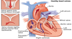 Cardiac Valve Replacement Surgery in india