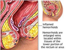 Haemorrhoids