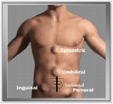 Hernia Type and Treatment 