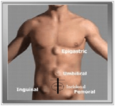  Hi-Tech “Hernia” Care at Safemedtrip affiliated Indian hospital