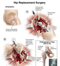 Total hip replacement