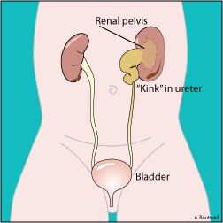 hydronephrosis