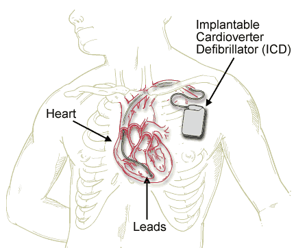 Implantable Cardiac Defibrillators