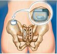 Interstim therapy and Botox