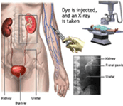 Diagnosis of Kidney Stones