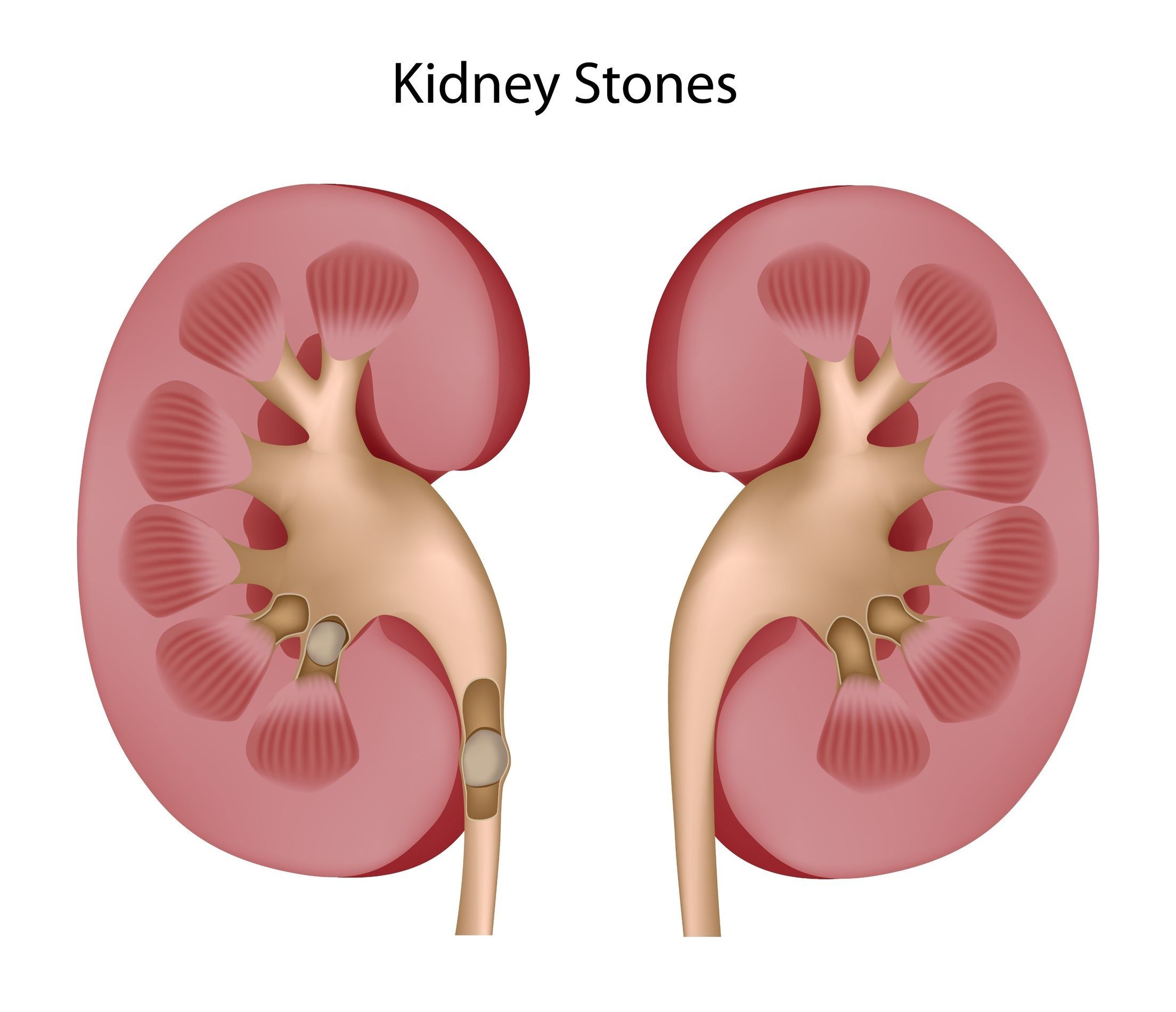 Advanced Laser Lithoripsy Affordable Kidney Stone Treatment In India Safemedtrip