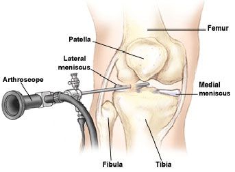 Knee Arthroscopic