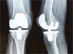 Total Knee Replacement