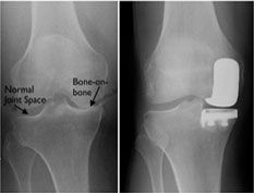 Partial Knee Replacement