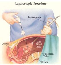 Highly Advanced Minimally Invasive Surgery for Ovarian Cancer