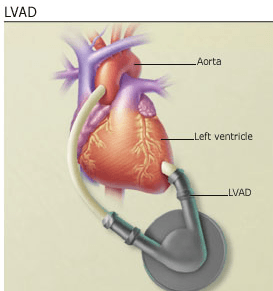 LVAD/ VAD Left ventricular Assist Device or Ventricular Assist Device