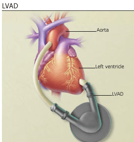 Ventricular Assist Devices