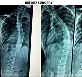 Scoliosis Surgery - Treatment in Children & Surgery | Safemedtrip